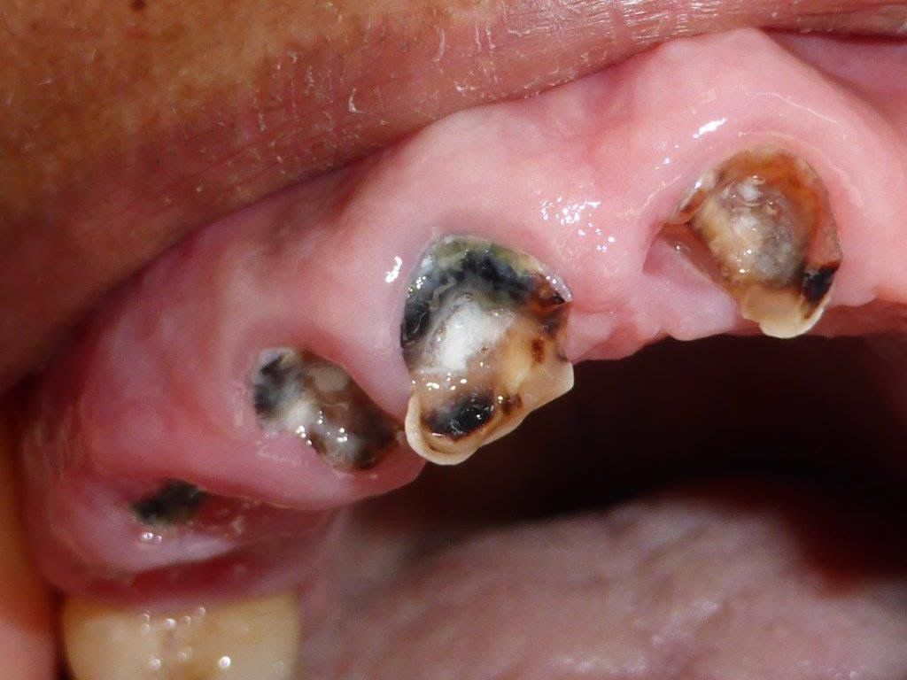 Vanuatu suffering from poor oral health